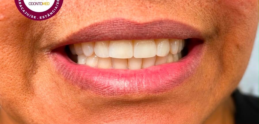 Sorriso antes e depois de reabilitação com prótese sobre implante — depois