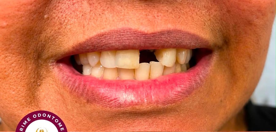 Sorriso antes e depois de reabilitação com prótese sobre implante — antes
