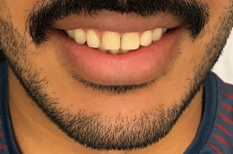Sorriso antes e depois de tratamento ortodôntico — antes