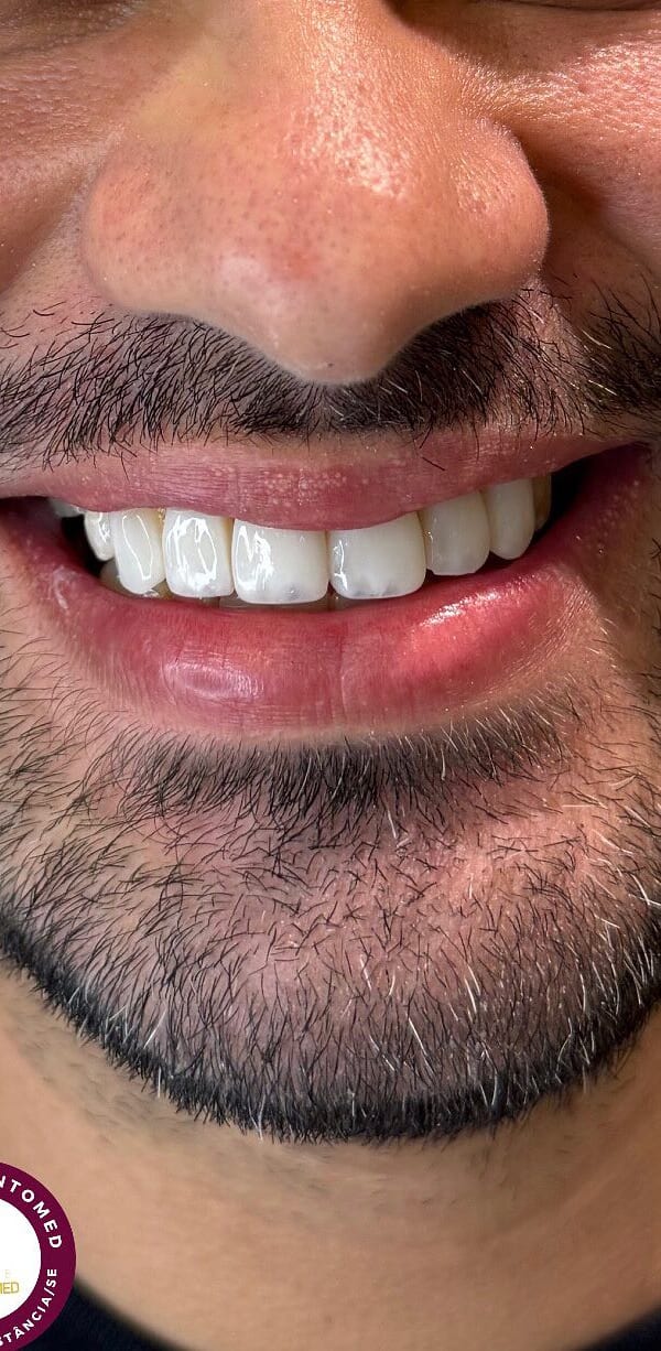 Sorriso após facetas de resina — paciente da Prime Odontomed