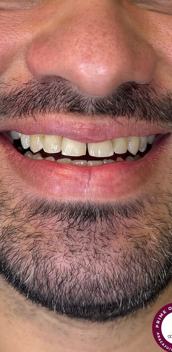 Sorriso antes e depois de facetas de resina — antes